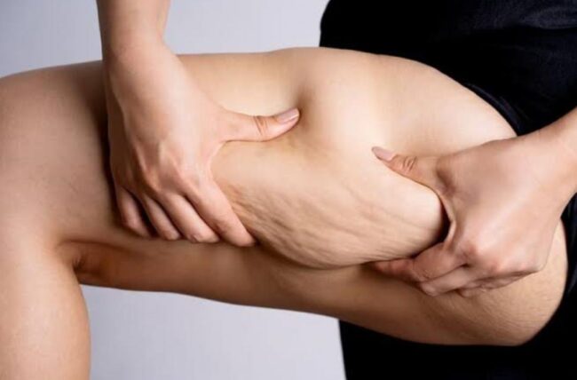 Por que tantas mulheres ainda sofrem por anos sem diagnóstico do lipedema?