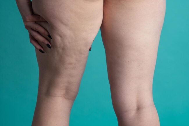 Junho roxo alerta para sinais do lipedema