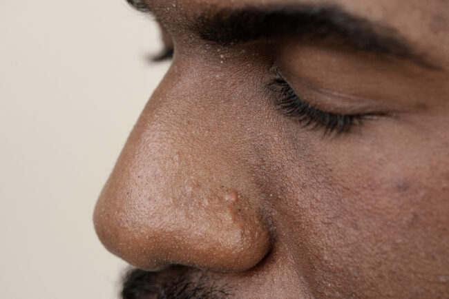 Pesquisa do hupes para tratar acne em homens trans negros conquista prêmio