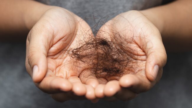 Quando os fios vão embora: especialistas falam sobre alopecia