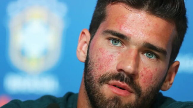 Os sinais da doença revelada por alisson becker